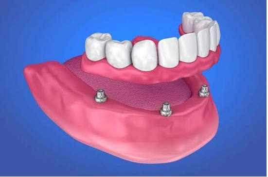Dentist Supports